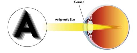 Astigmatism