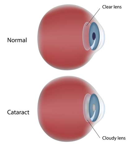 Cataracts