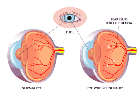 Diabetic Retinopathy Illustration