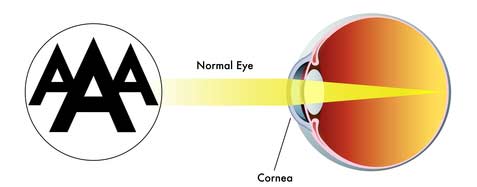 Normal Focus