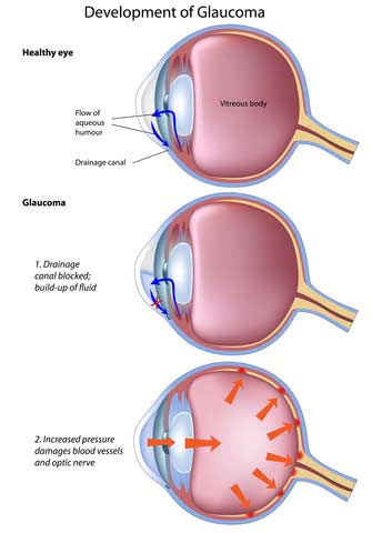 Glaucoma Illustration