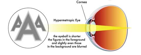 Hyperopic Focus