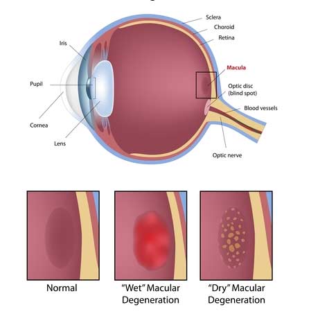 Macular Degeneration Illustration