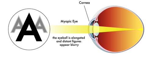 Myopic Focus